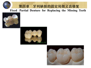 固定义齿修复学：4-6 固定桥的制作及修复后可能出现的问题