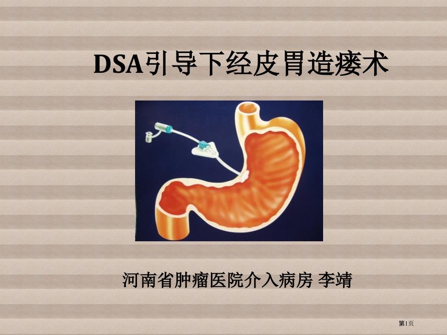 DSA引导下经皮胃造瘘术医学知识讲解_第1页