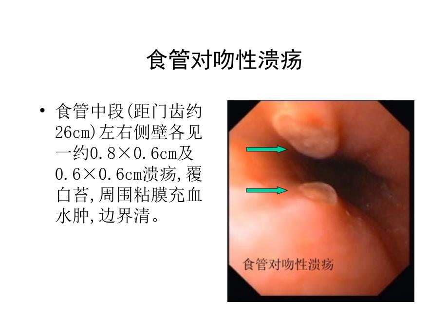 典型内镜图片课件_第1页