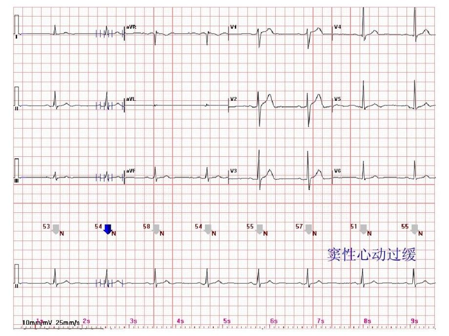 心电图常见正常和异常心电图图谱27张课件_第1页