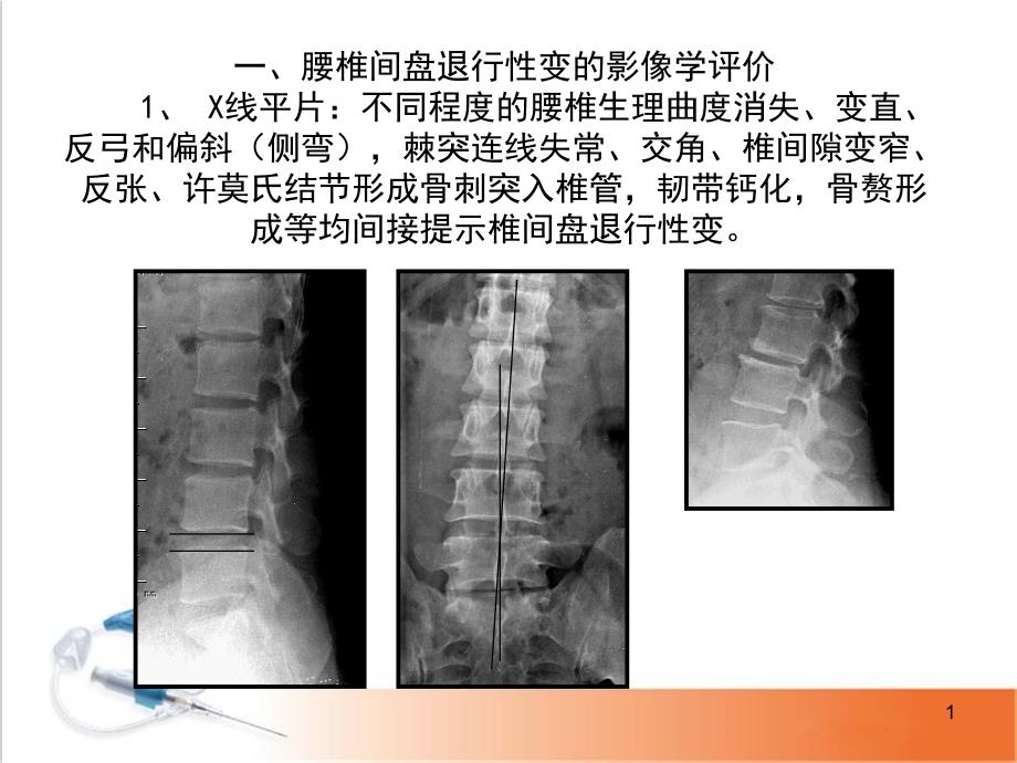 腰椎退变PPT演示课件_第1页