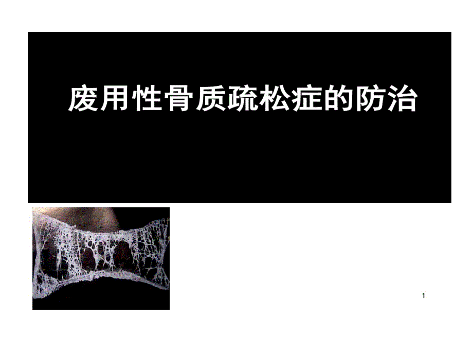 废用性骨质疏松诊断与治疗课件_第1页