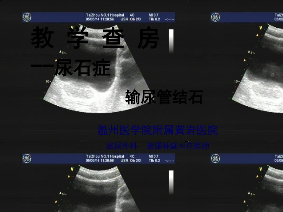 教学查房输尿管结石_第1页