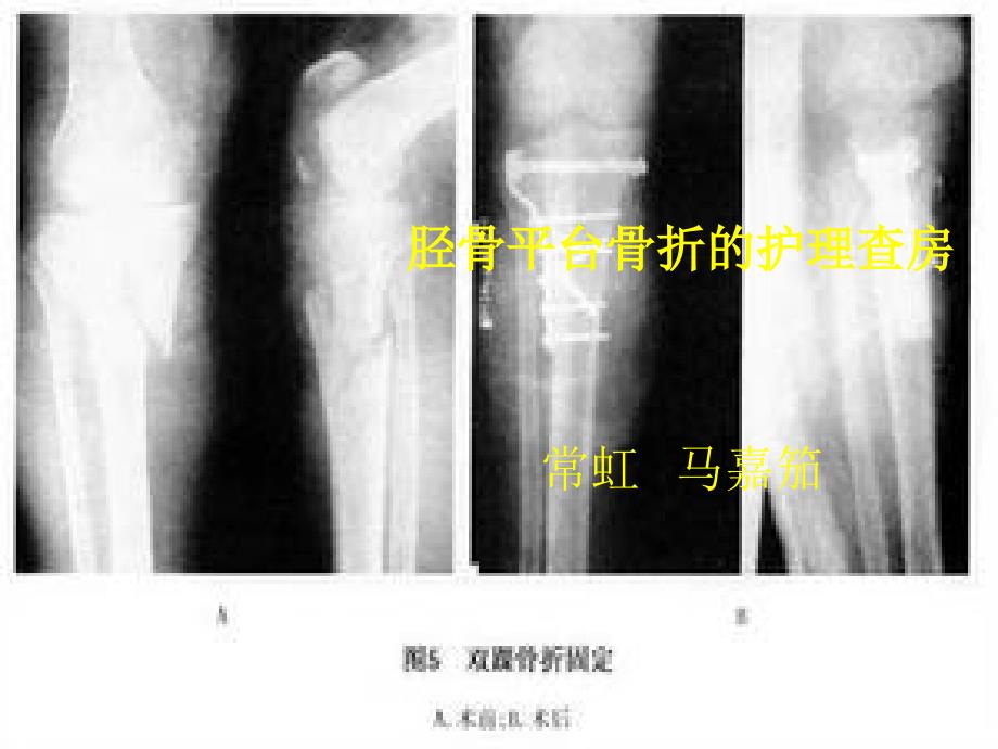 胫骨平台骨折的护理查房_第1页