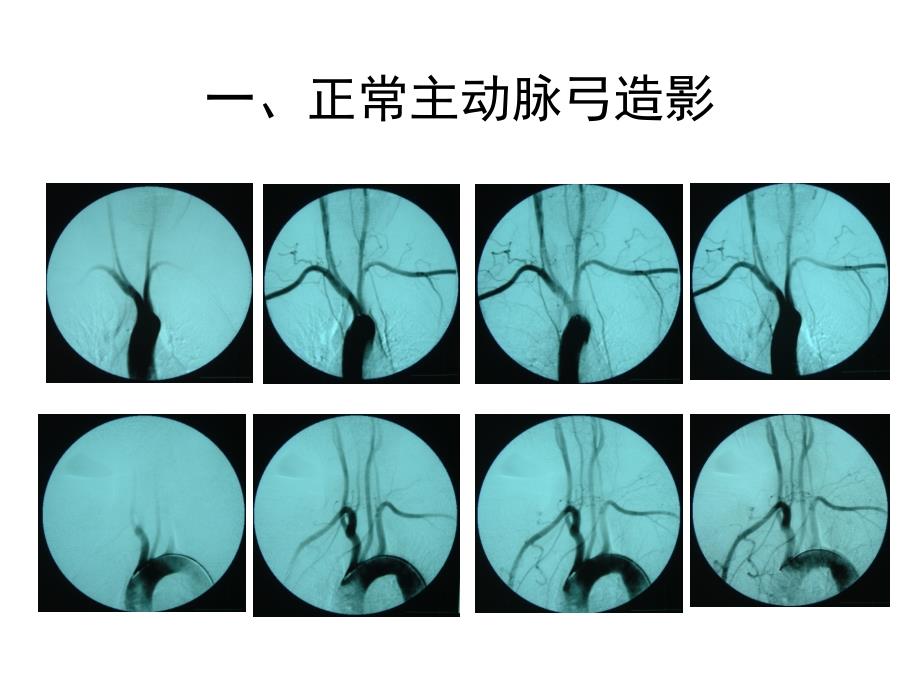 正常脑血管造影_第1页