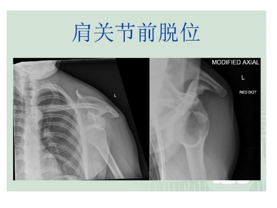 肩关节脱位手法复位_第1页