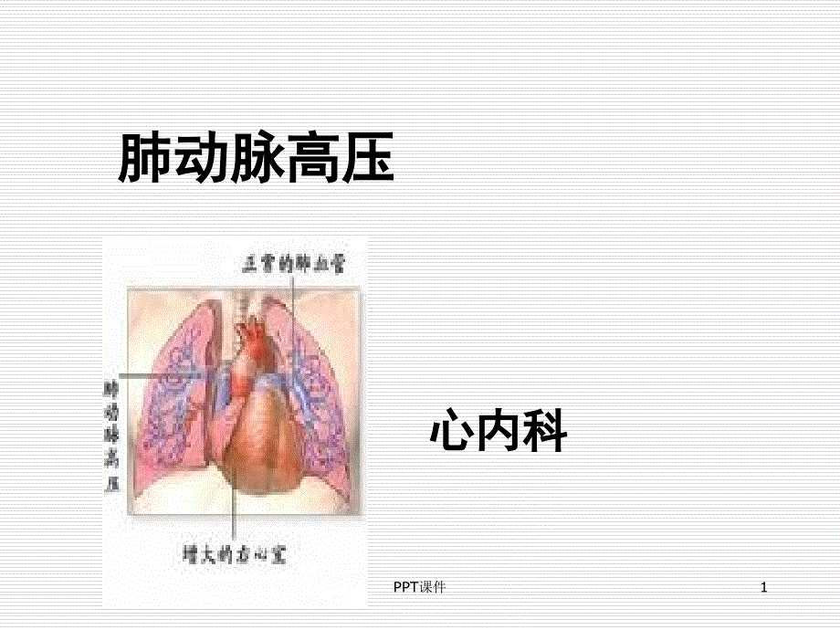 肺动脉高压【心内科】-课件_第1页