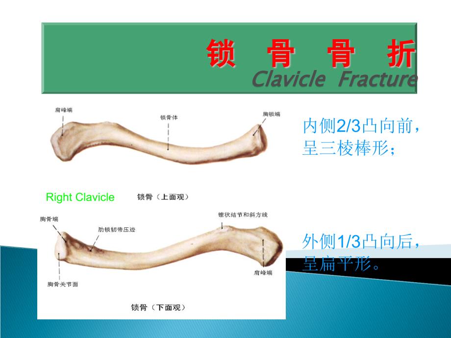 锁骨骨折ppt课件_第1页