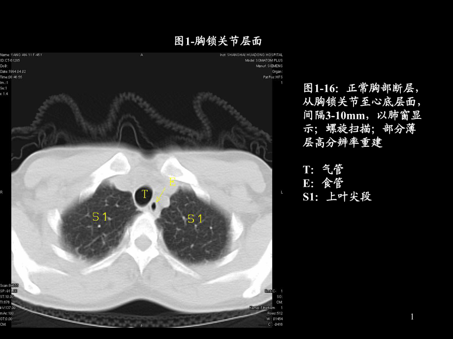 胸部CT的正常结构及肺部疾病的影像学表现_第1页