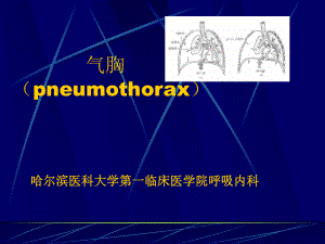 氣胸pneumothorax