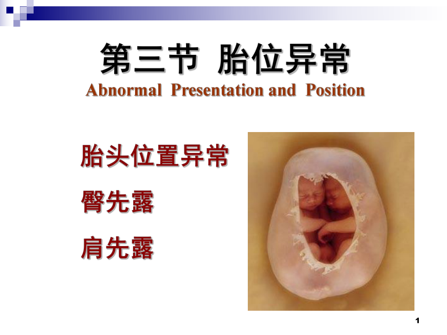 胎位异常教案文档资料_第1页