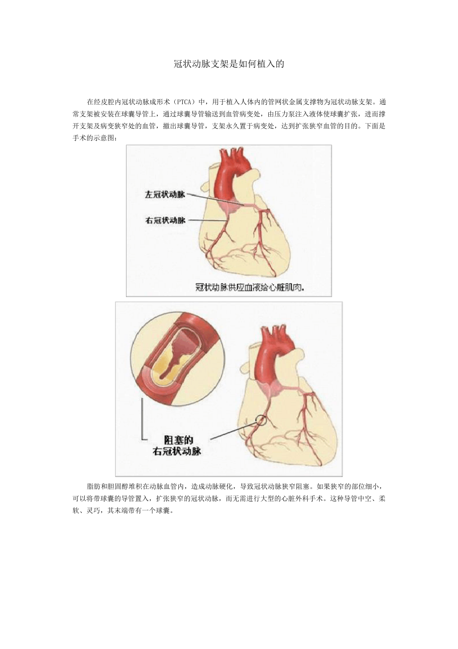 冠状动脉支架是如何植入的_第1页