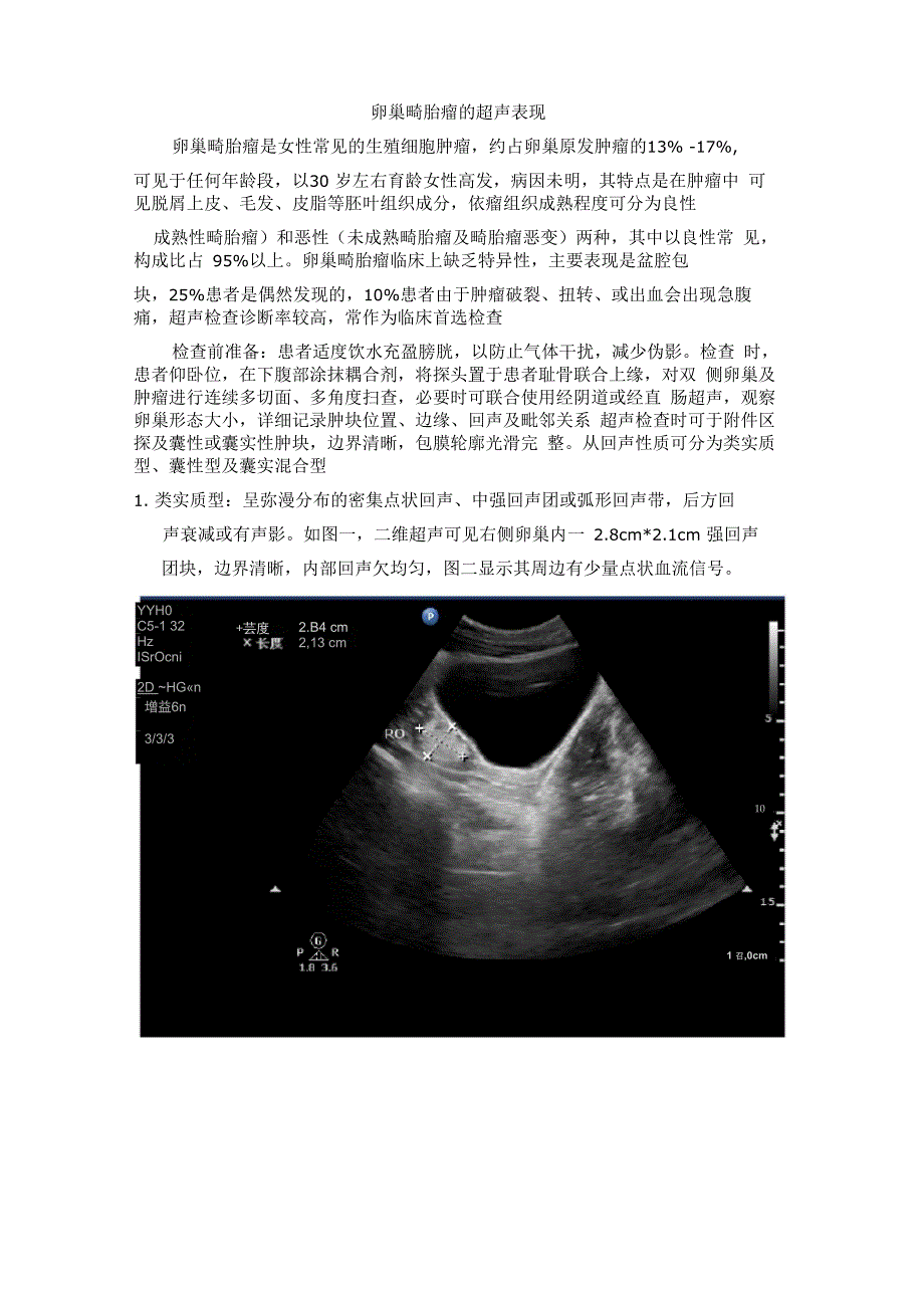 卵巢畸胎瘤的超声表现_第1页