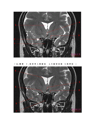鞍区垂体MRI解剖