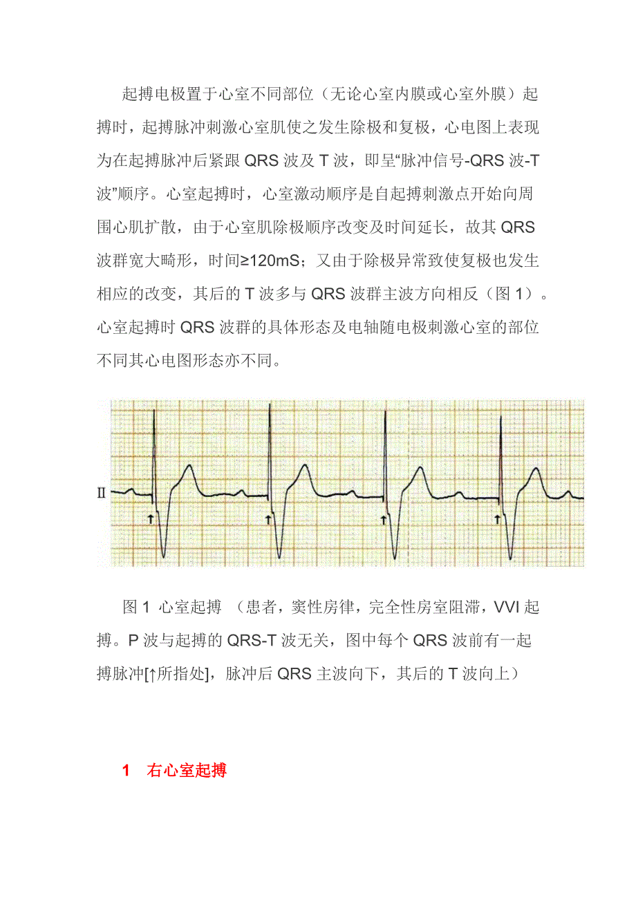 图解心室不同部位起搏心电图_第1页