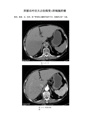肝脏右叶巨大占位病变--肝细胞肝癌